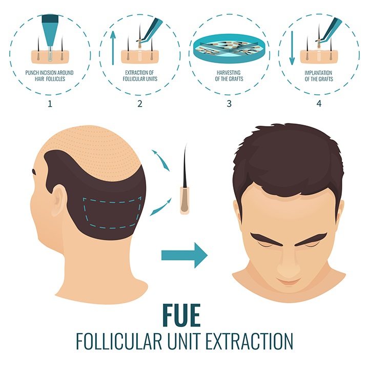 FUE_Follicular_Unit_Extraction Stambuł.jpg